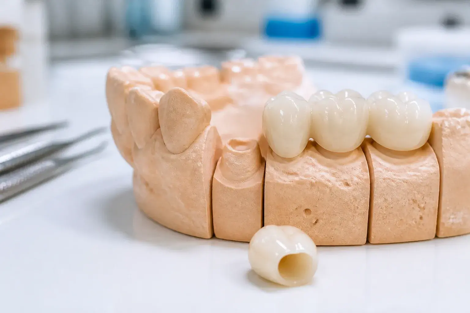 Can a dental crown fall off? hero background photograph
