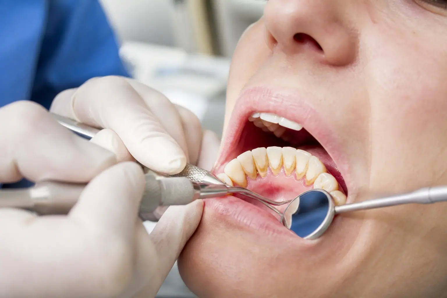 What is dental calculus? hero background photograph
