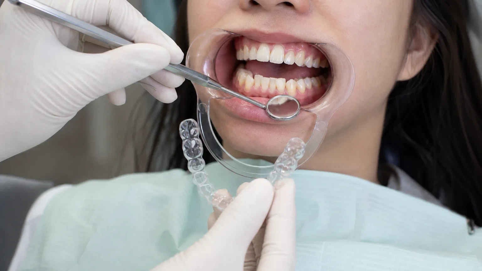 Dental models showing crowded teeth beside a clear aligner tray