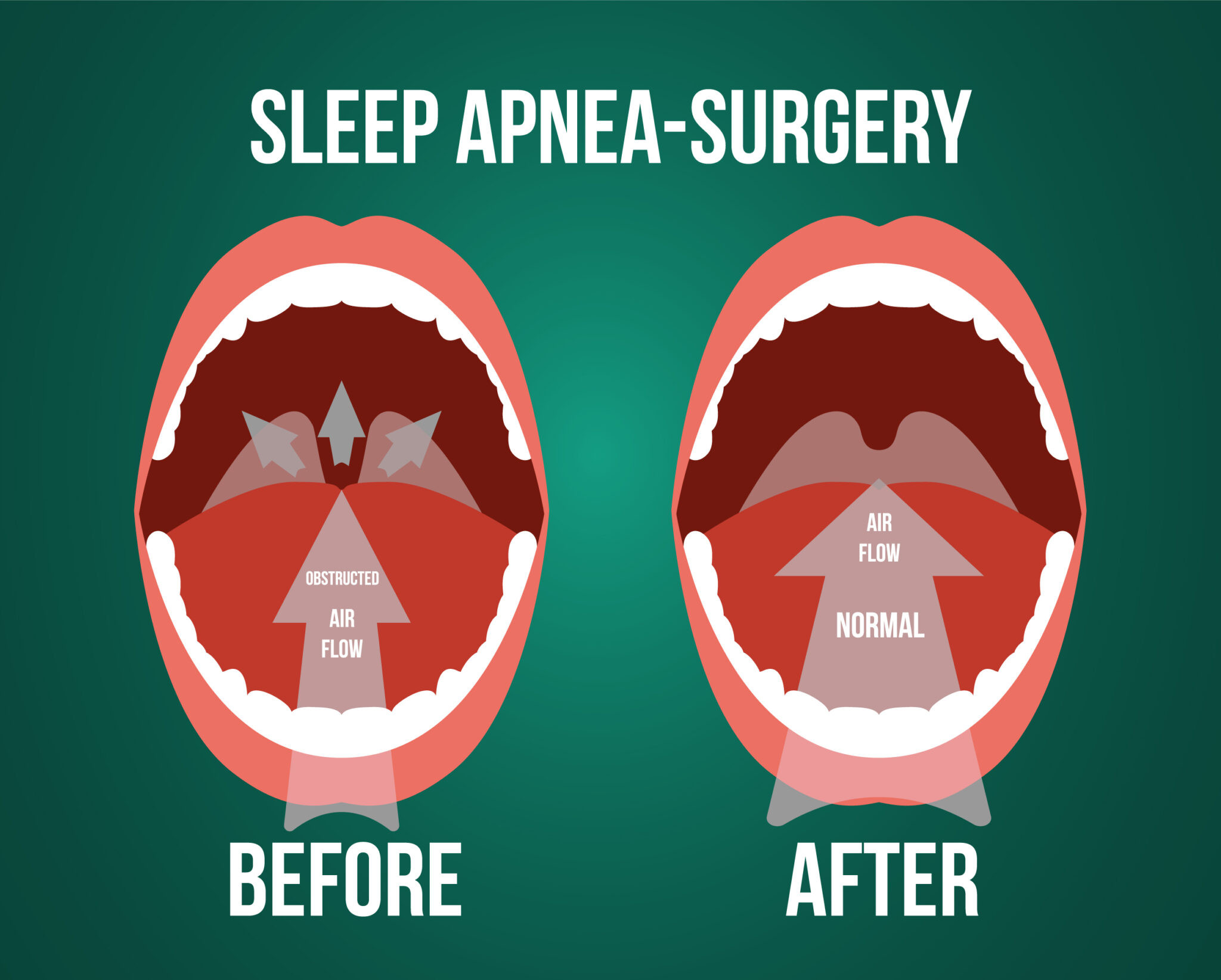 What is Somnoplasty for Snoring?