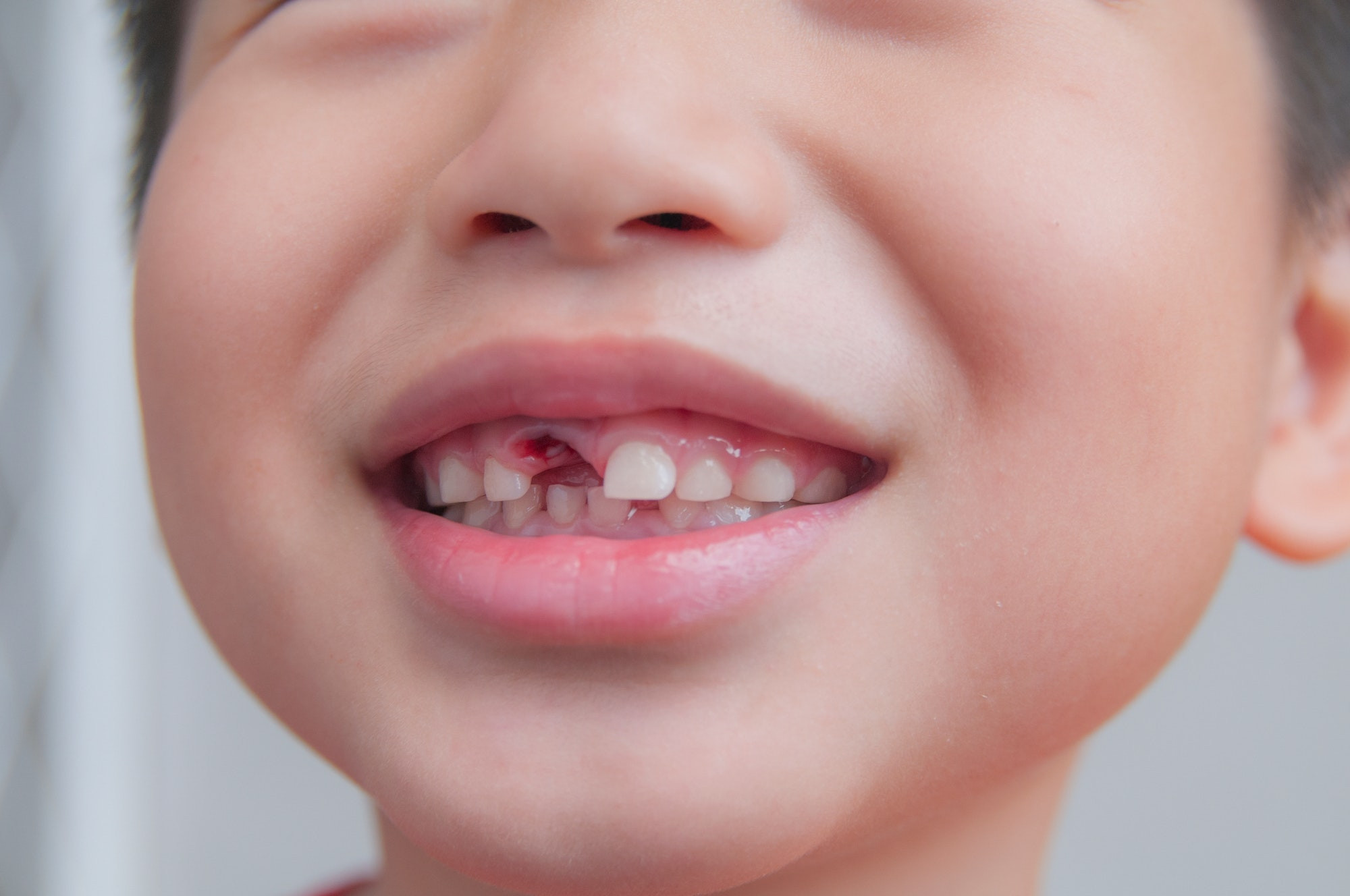 Dental Procedures for Replacing Missing Teeth