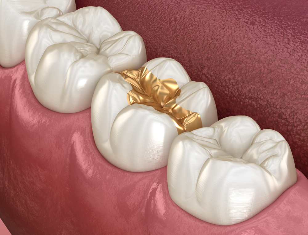 Dental Inlays and Onlays