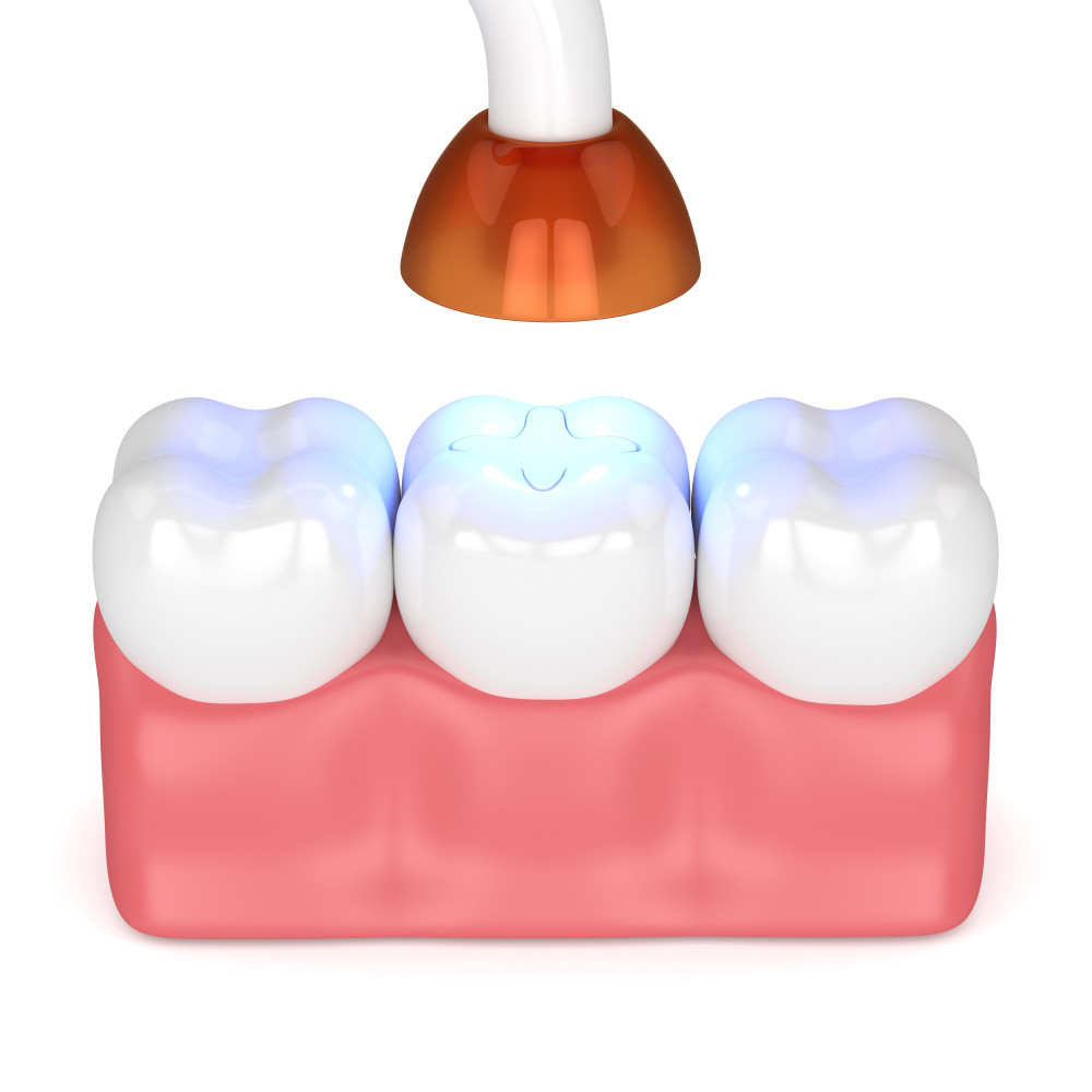 Top 10 Dental Curing Light Shields