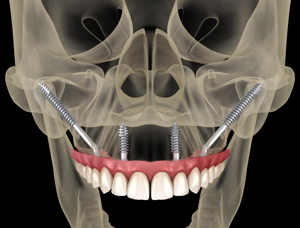 What are Zygomatic Dental Implants