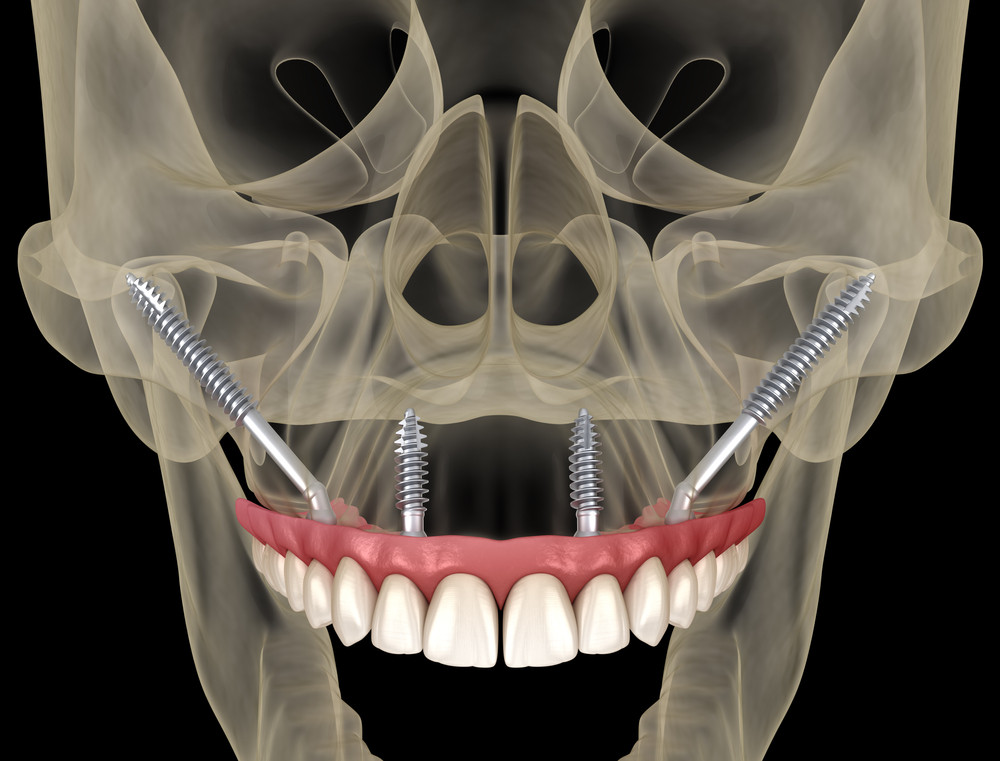 Top 21 Dental Implant Companies
