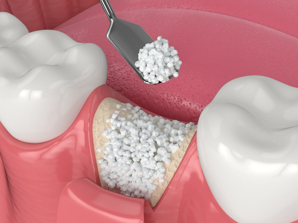 Top 10 Bone Regeneration Materials for Dental Surgery and Periodontal Use