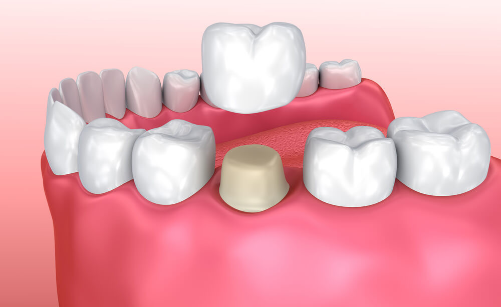 Top 10 Conventional Dental Cement