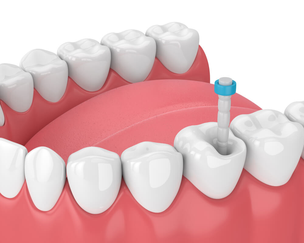 Top 10 Endodontic Metal Posts in Dentistry