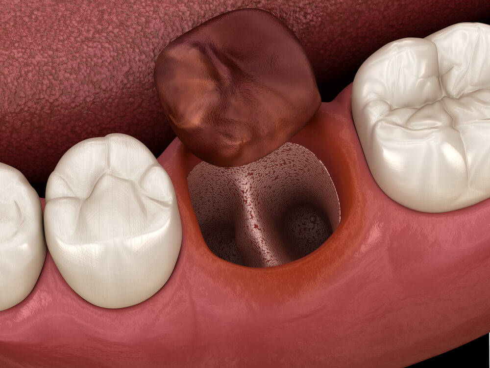 Top 10 Dry Socket Treatment
