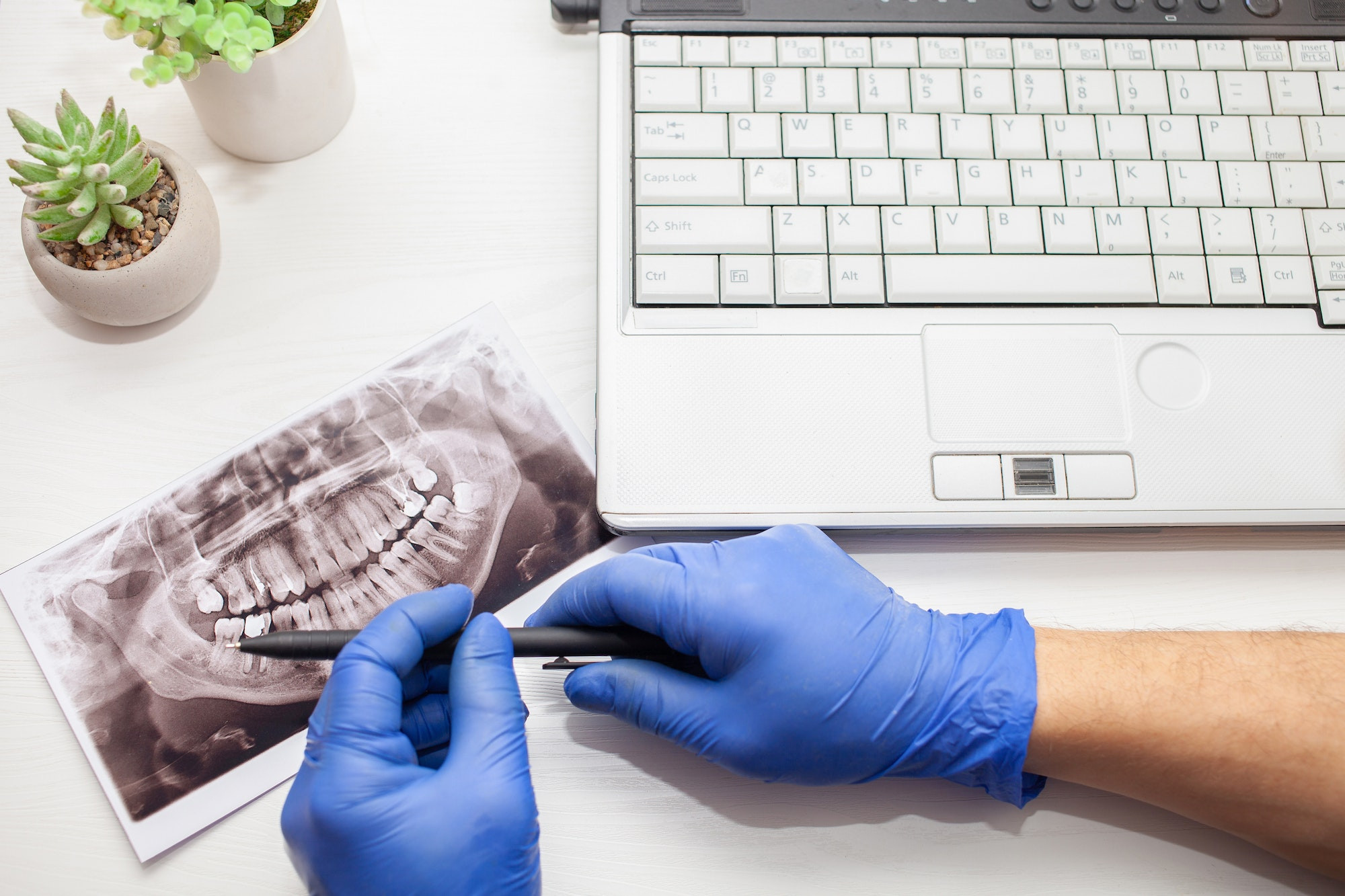 Should You Have Root Canal Treatment on a Wisdom Tooth?