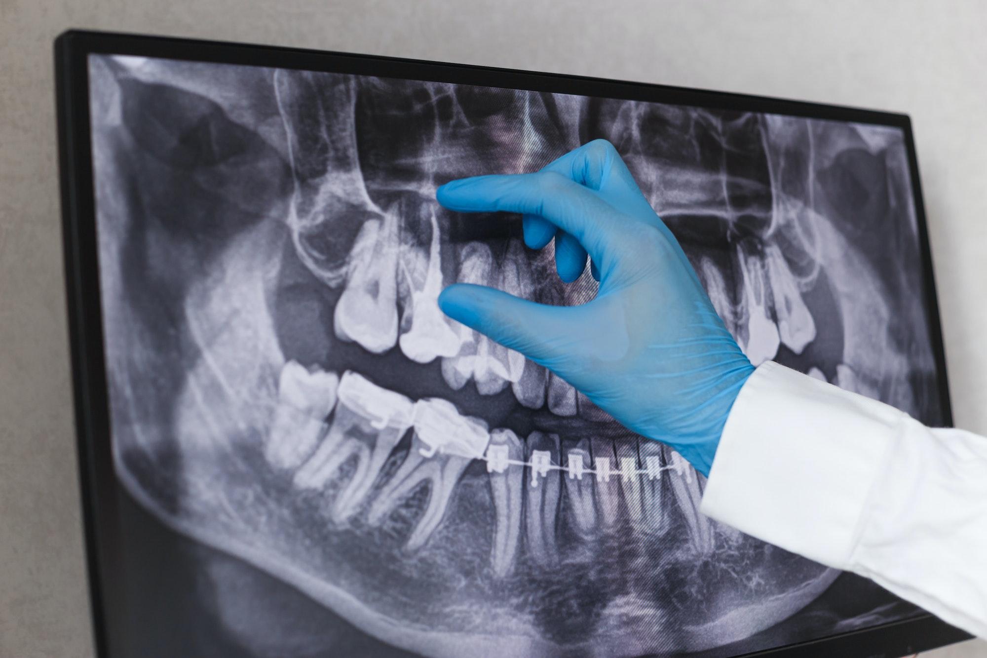 The Role Of Calcium Deposits In Causing Tooth Pain