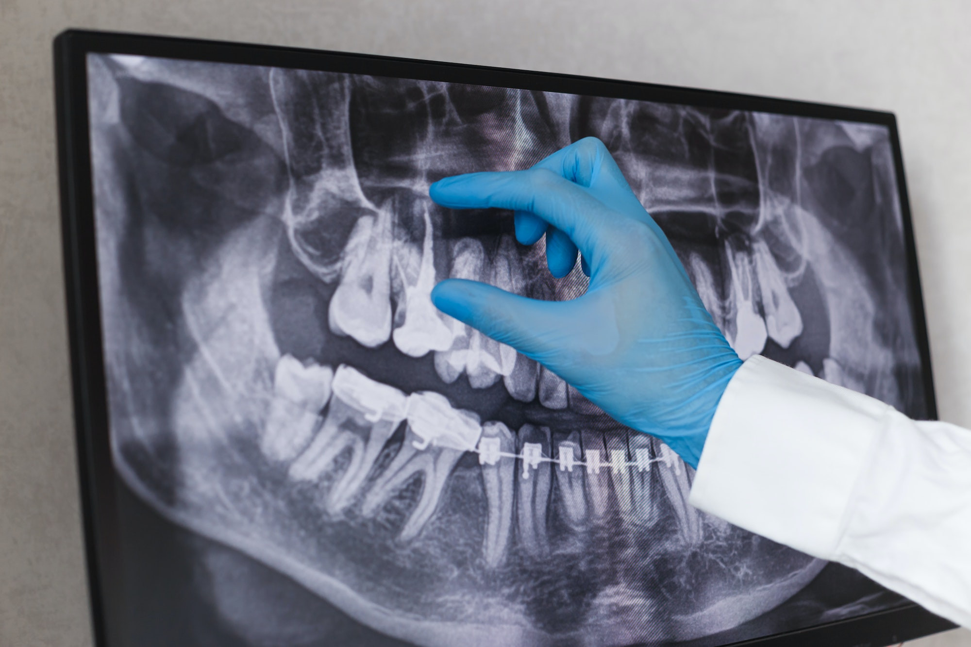 Understanding Root Canal Treatment for Front Teeth