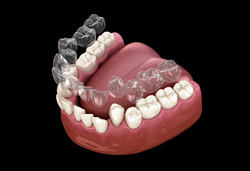 Can children use clear aligners, or are they only for adults?
