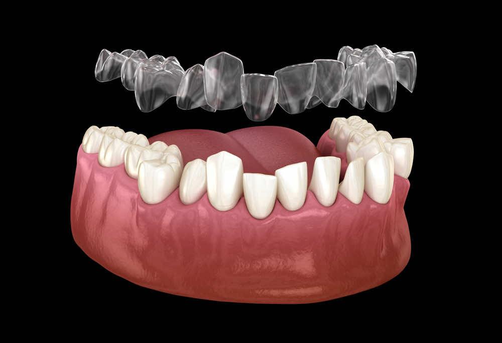 How often do I need to wear clear aligners each day?