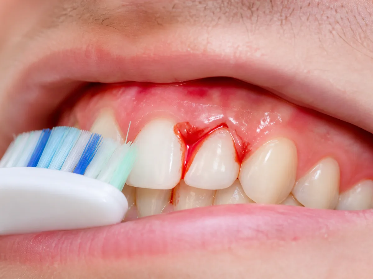 Close view of puffy bleeding gums being checked with dental mirror