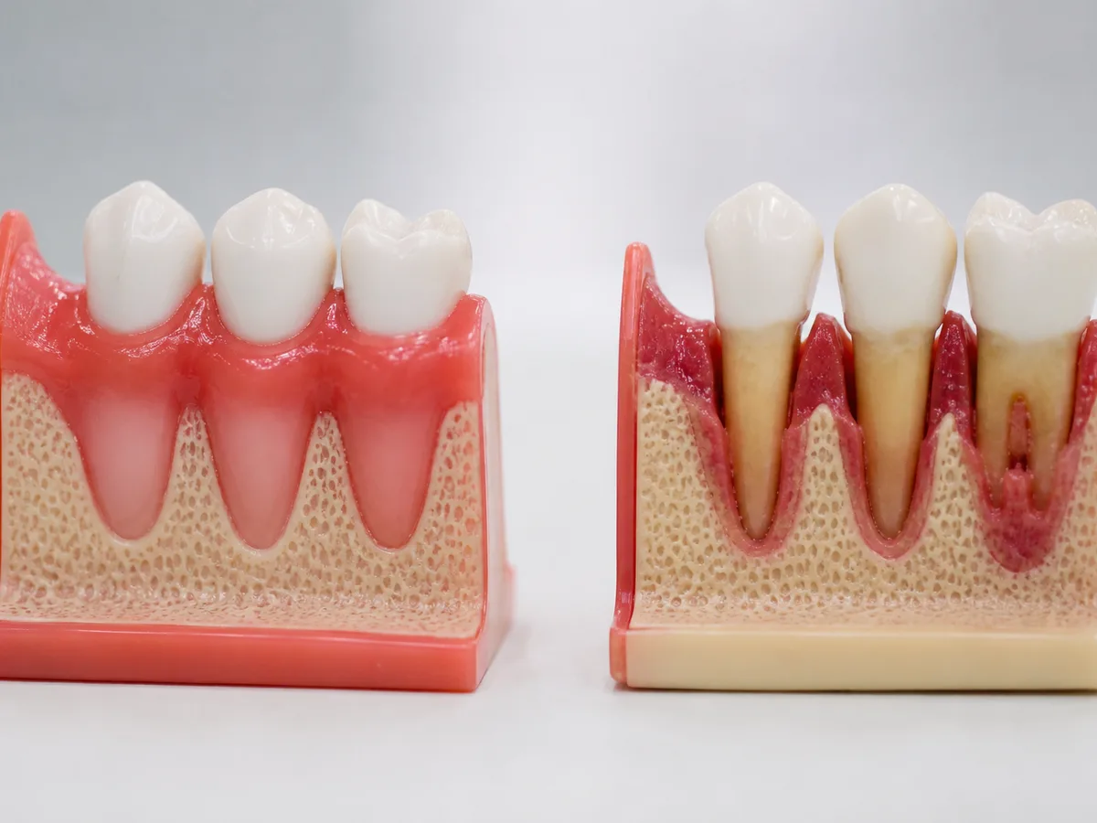 Gum pocket probe beside models showing gingivitis and periodontitis