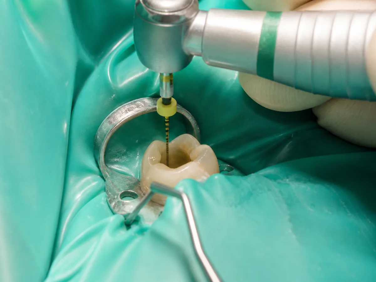 Dentist reviews a root canal X-ray next to an appointment schedule