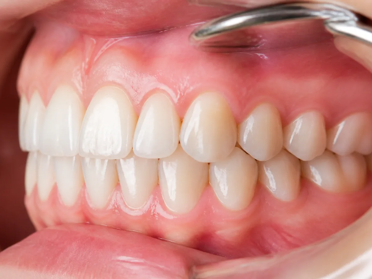 Stage chart showing gingivitis before periodontitis bone loss
