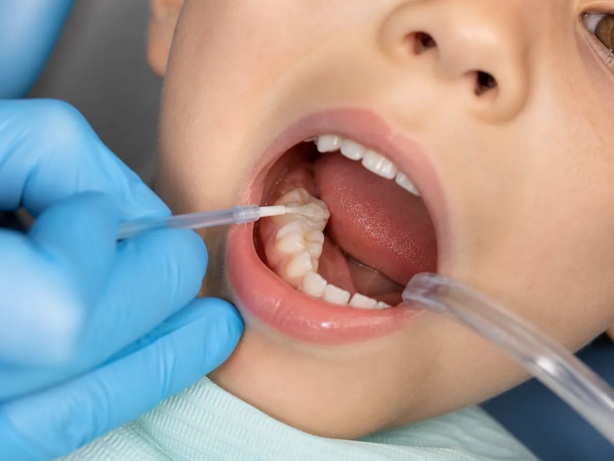 Dental hygienist painting sealant material onto a child's molar