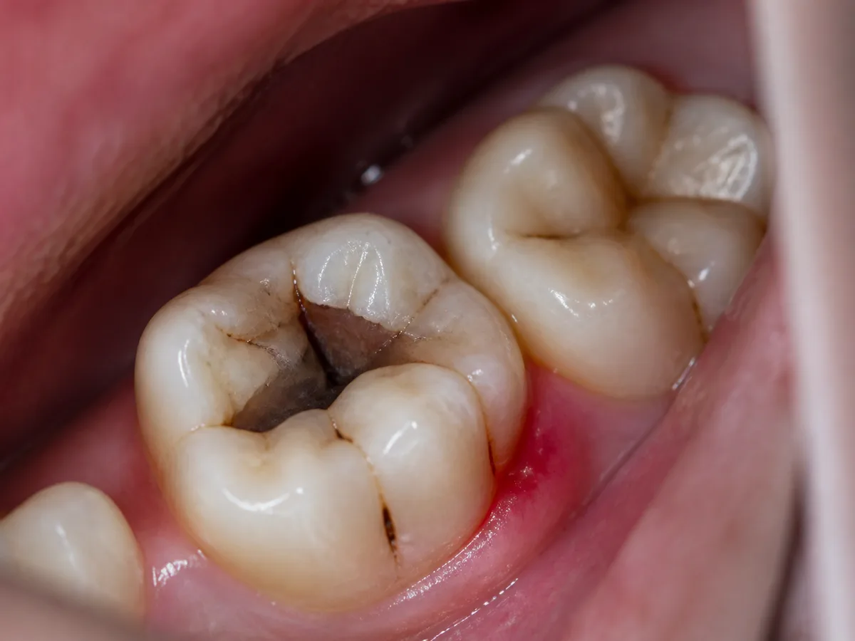 Dentist uses a cold test to evaluate a tooth for possible root canal treatment