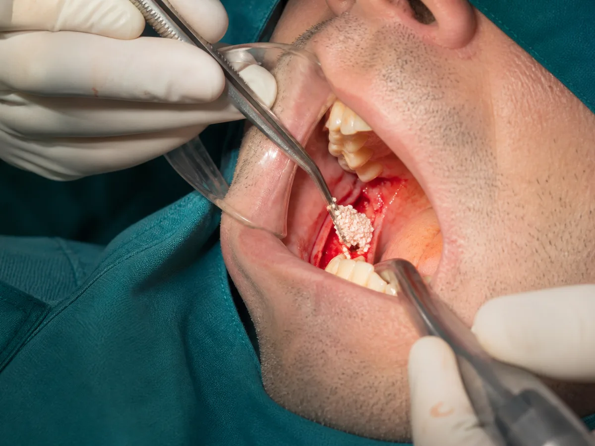 Oral surgeon placing bone graft material into a prepared dental implant site