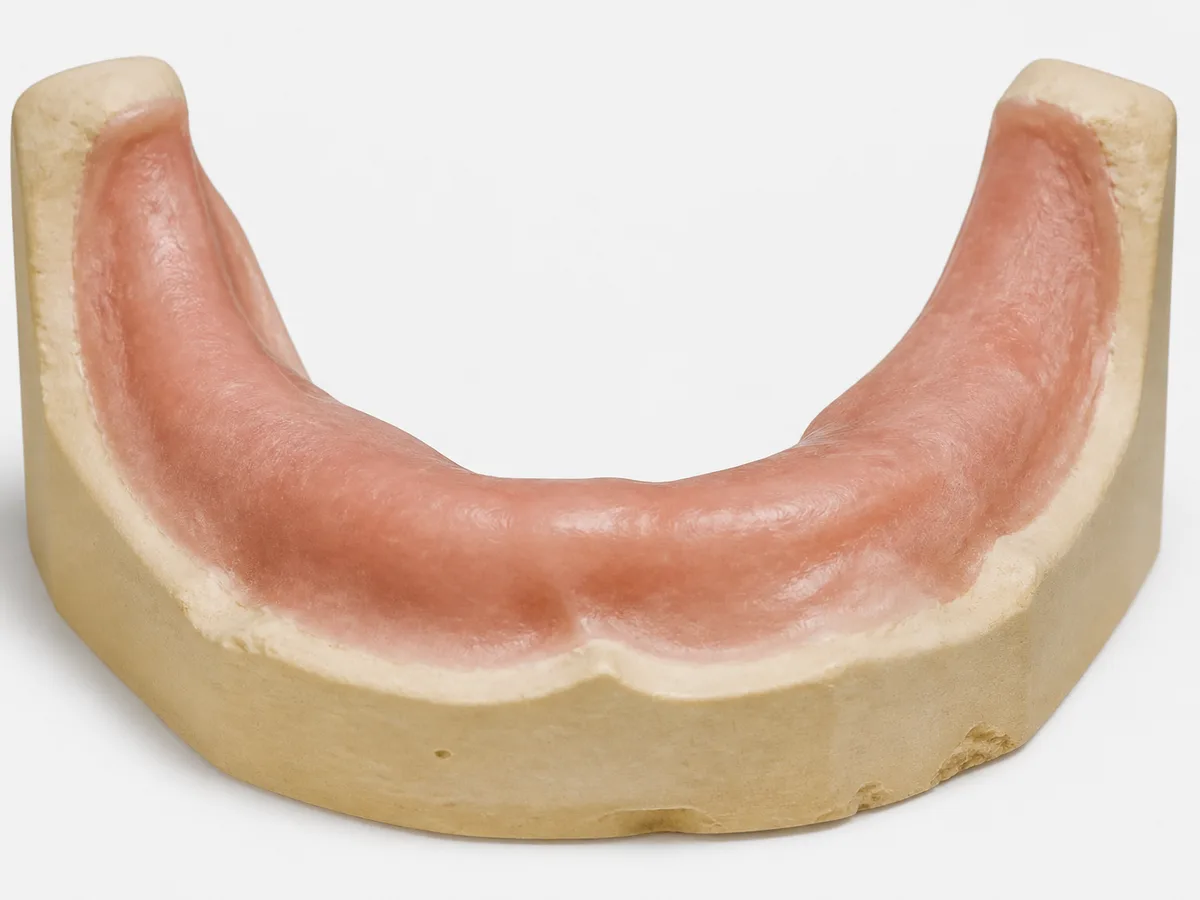 Healed dental ridge ready for implant placement after successful bone grafting