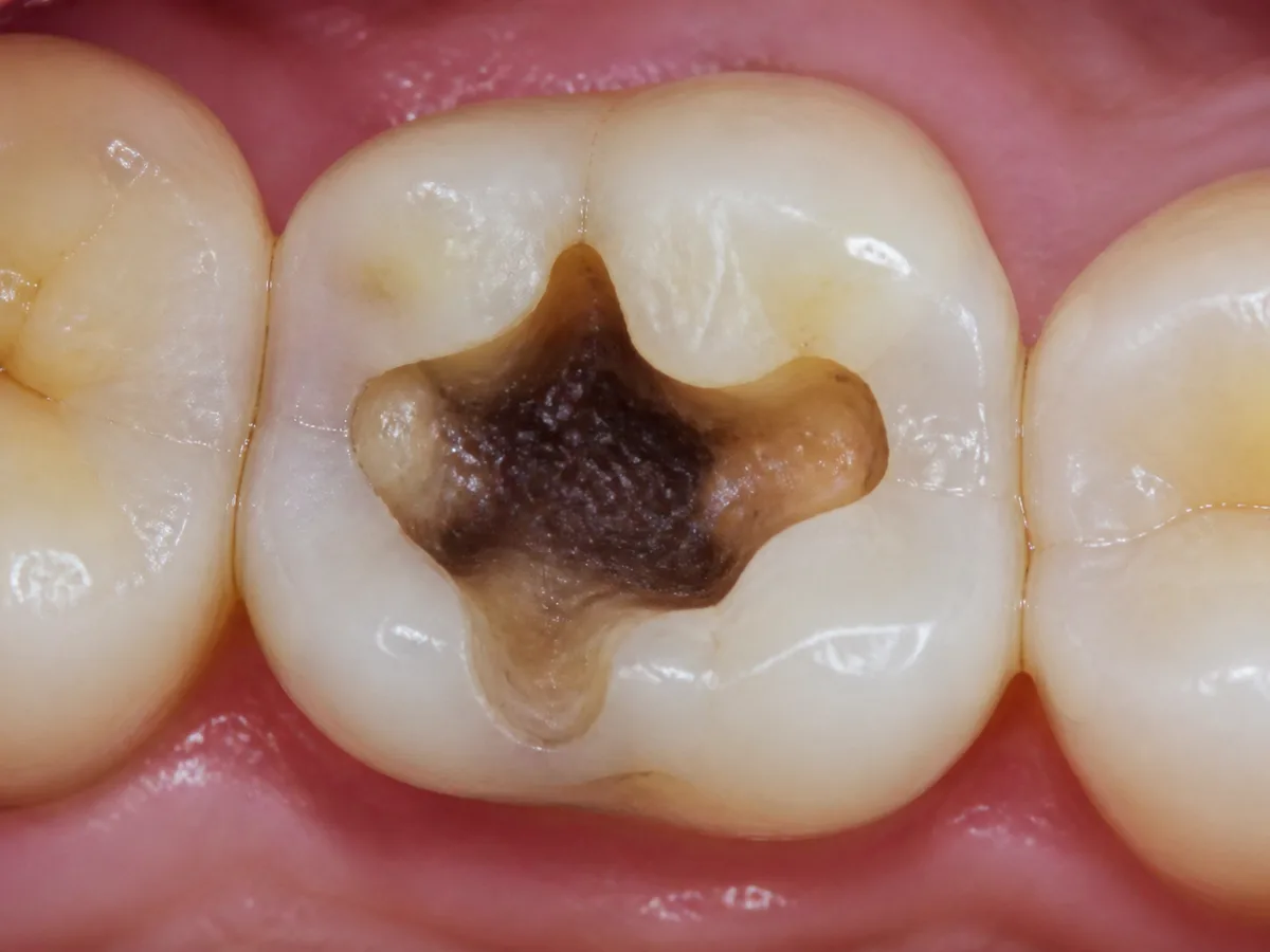 Temporary filling material being placed into a molar model