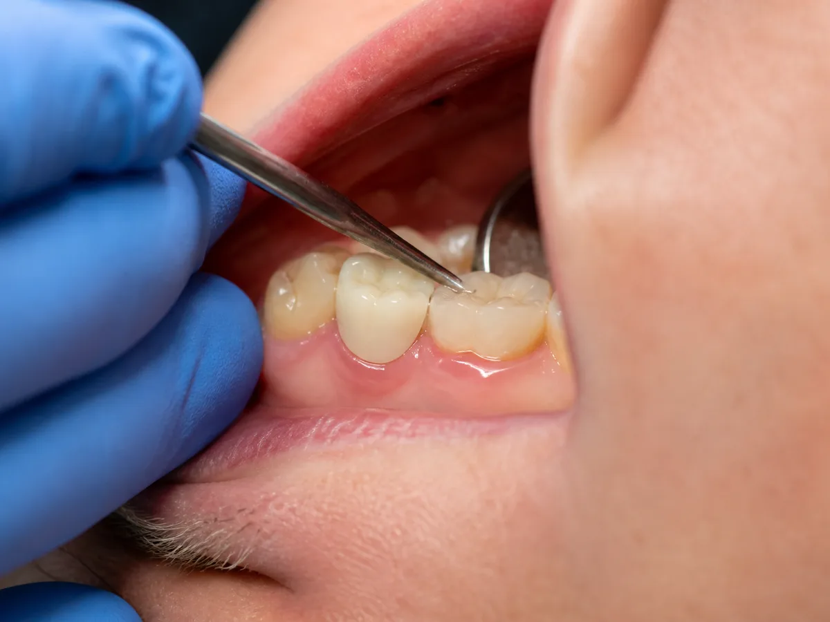 Dentist using blue bite paper to check a temporary crown