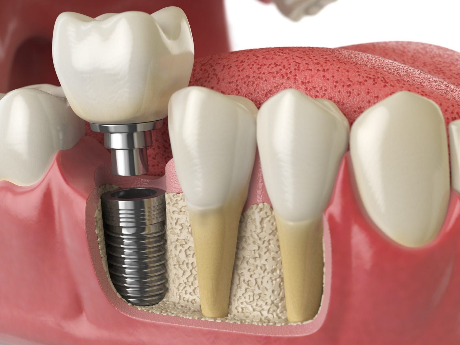Anatomy Of Healthy Teeth And Tooth Dental Implant In Human Dentu 1600x1200