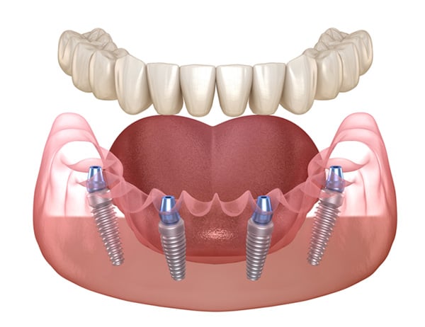 4 Implants Cost