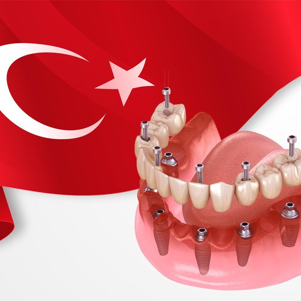 All-on-6-Dental-Implants-in-Turkey