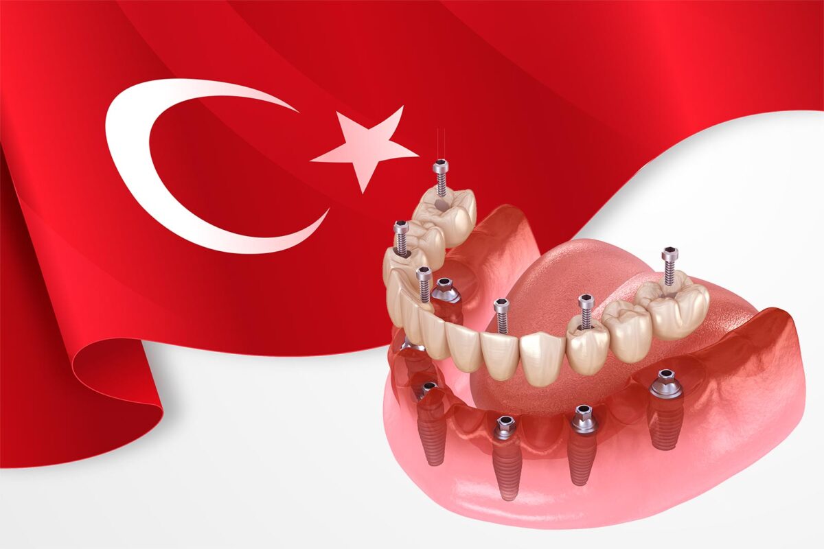 All-on-6-Dental-Implants-in-Turkey