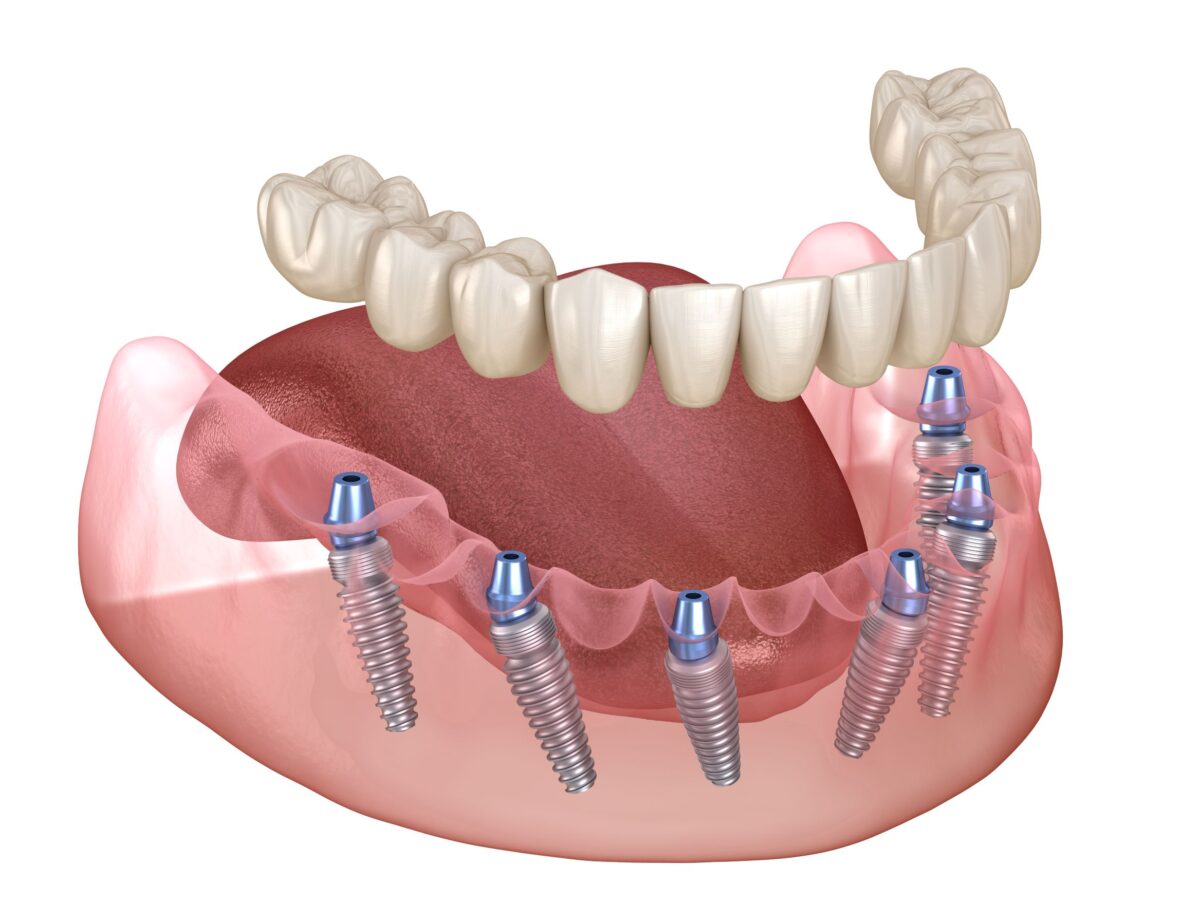 Full Dental Implants