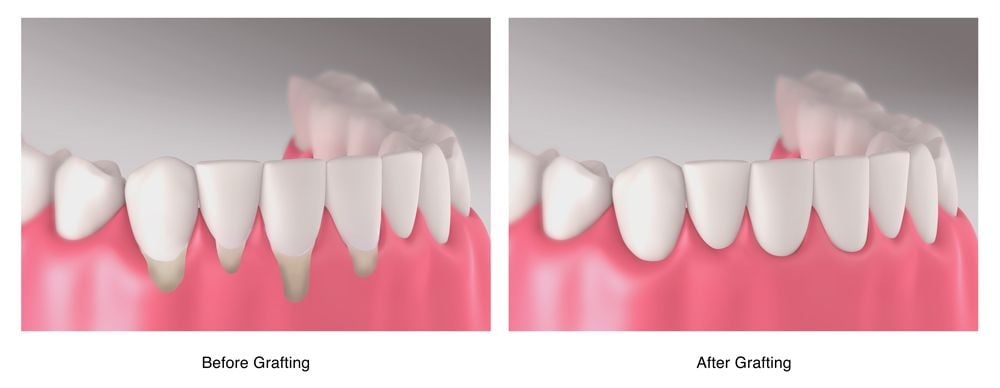 Gum Reconstruction