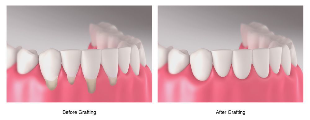 Gum Reconstruction