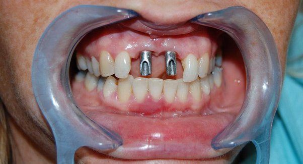 Lossing 2 Upper Front Teeth