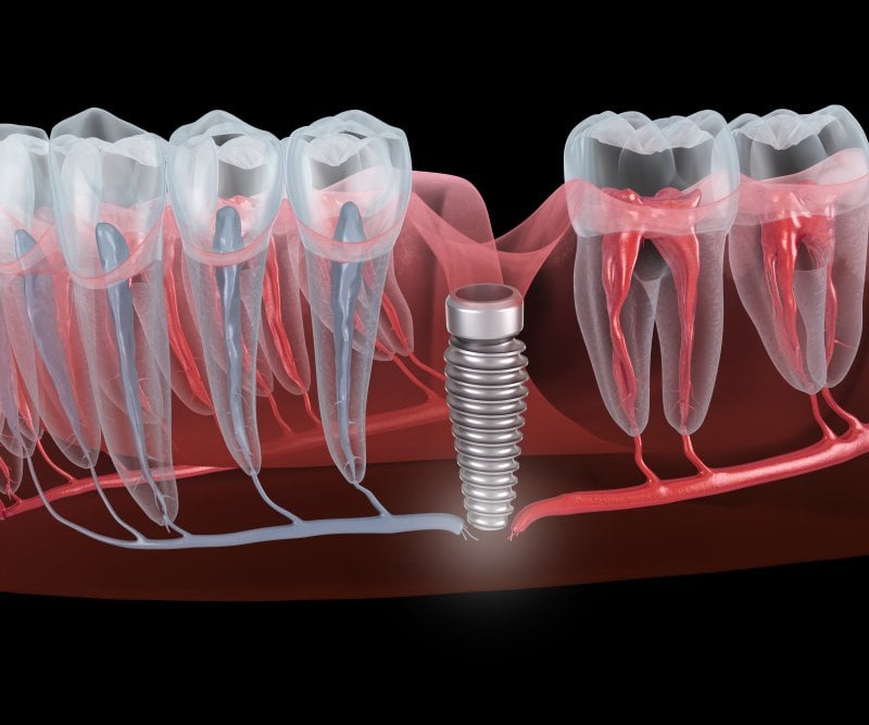 Nerve Damage After Implant