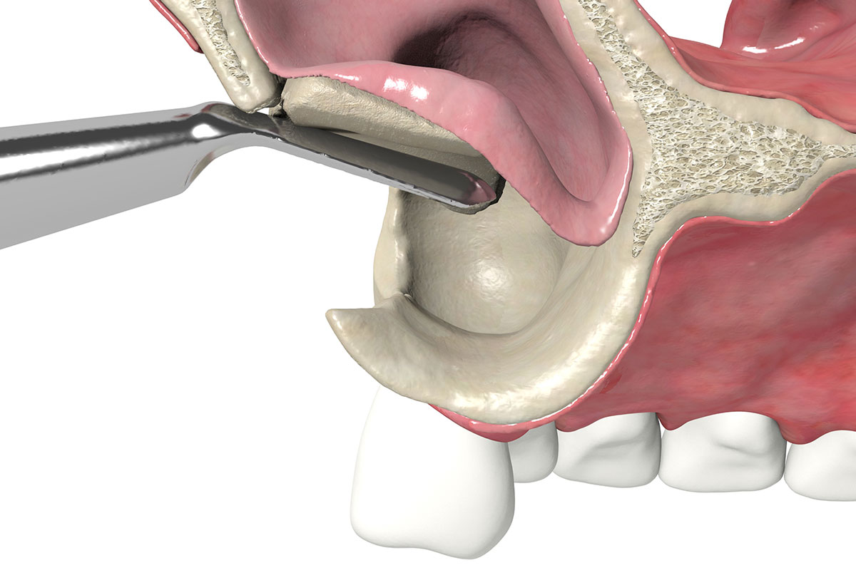 Sinus Lift