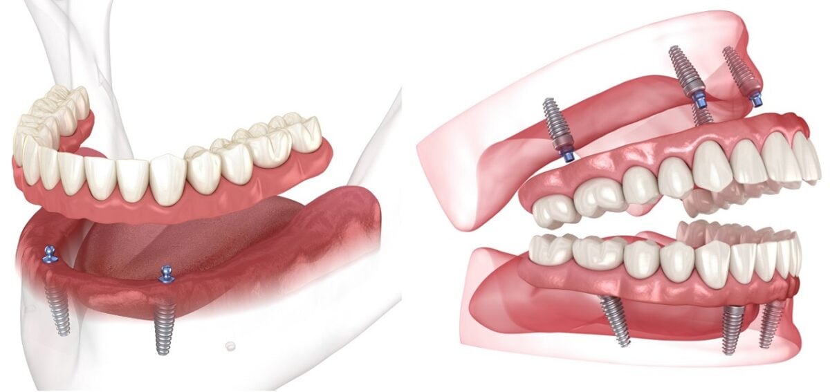 Snap In vs. Permanent Implants