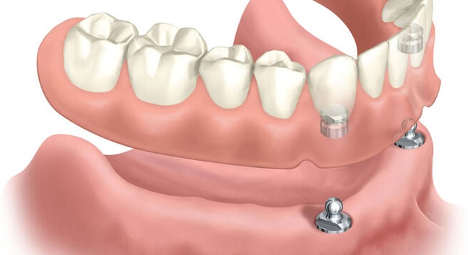 Snap in Dentures