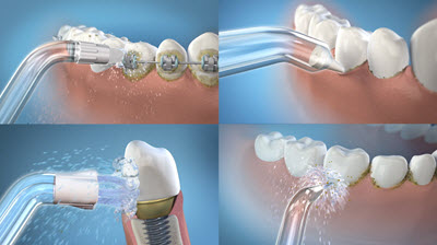 Waterpik Tutorial