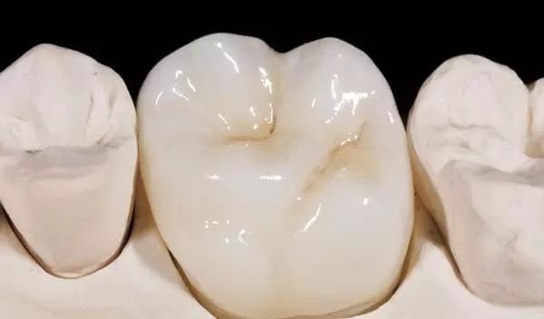 Zirconium for Molar Teeth