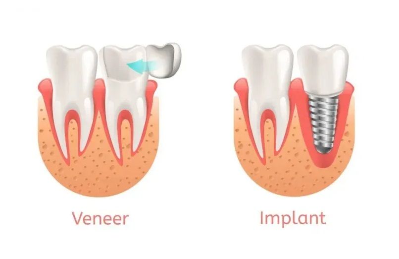veneers vs implants