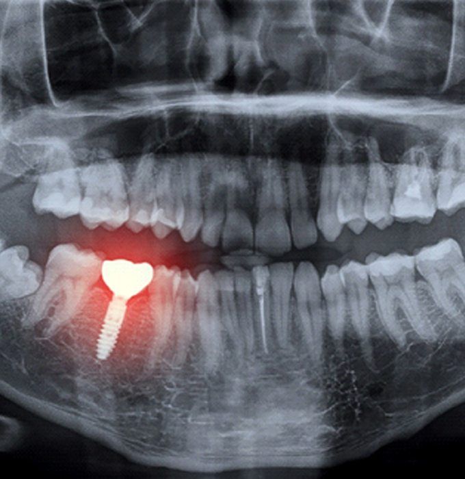Dental Implant Failure