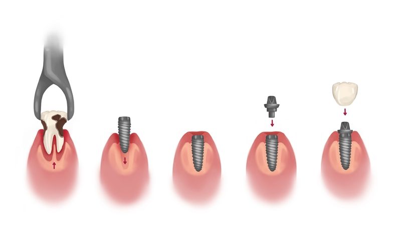Extraction with Implant on Same Day