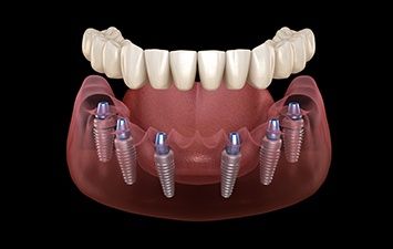 PF1 Hybrid 6 Dental Implants