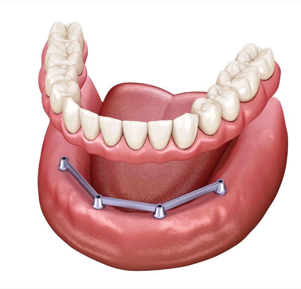 Removable Implant Dentures
