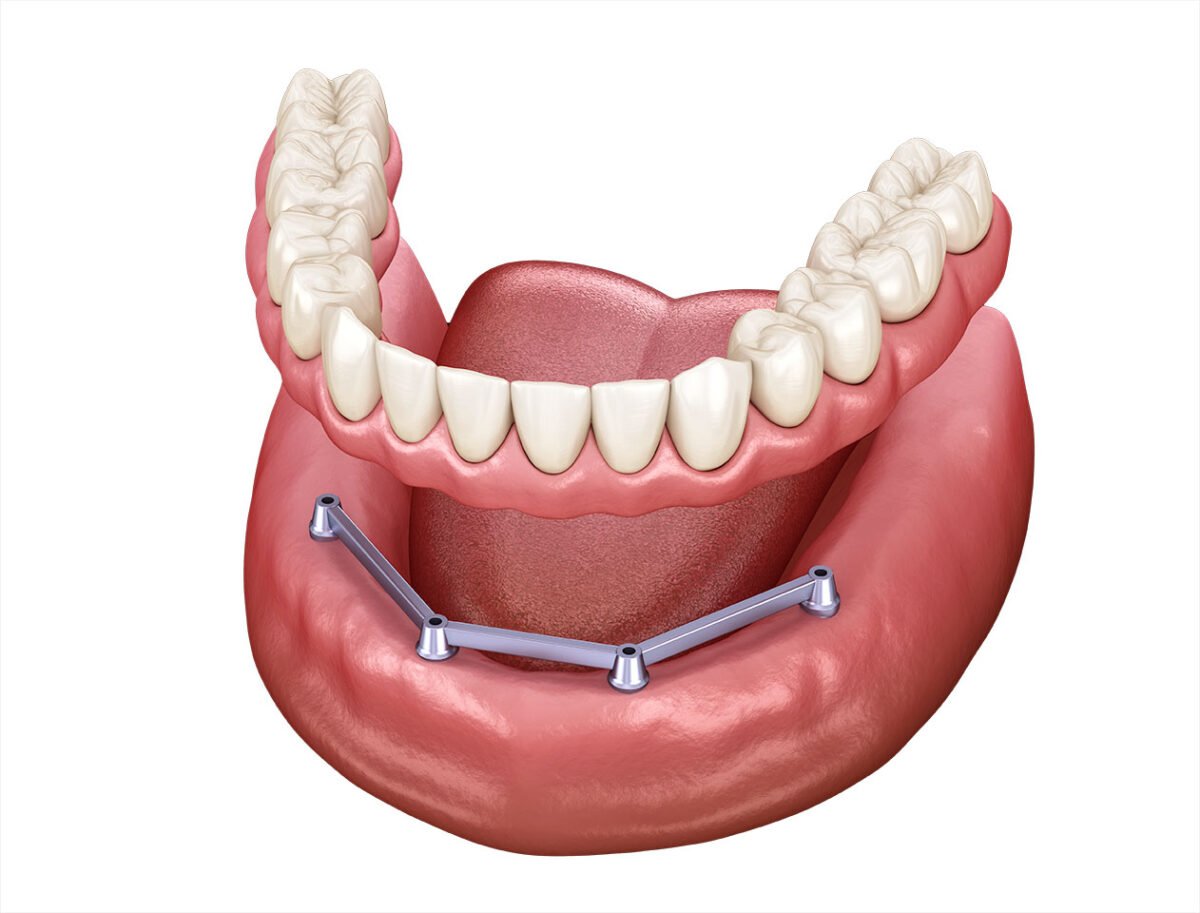 Removable Implant Dentures