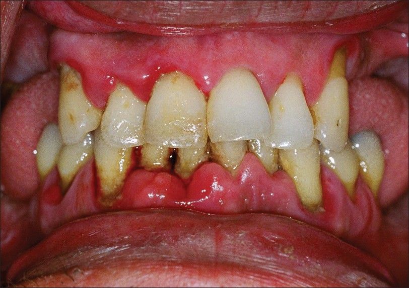 chronic periodontal disease
