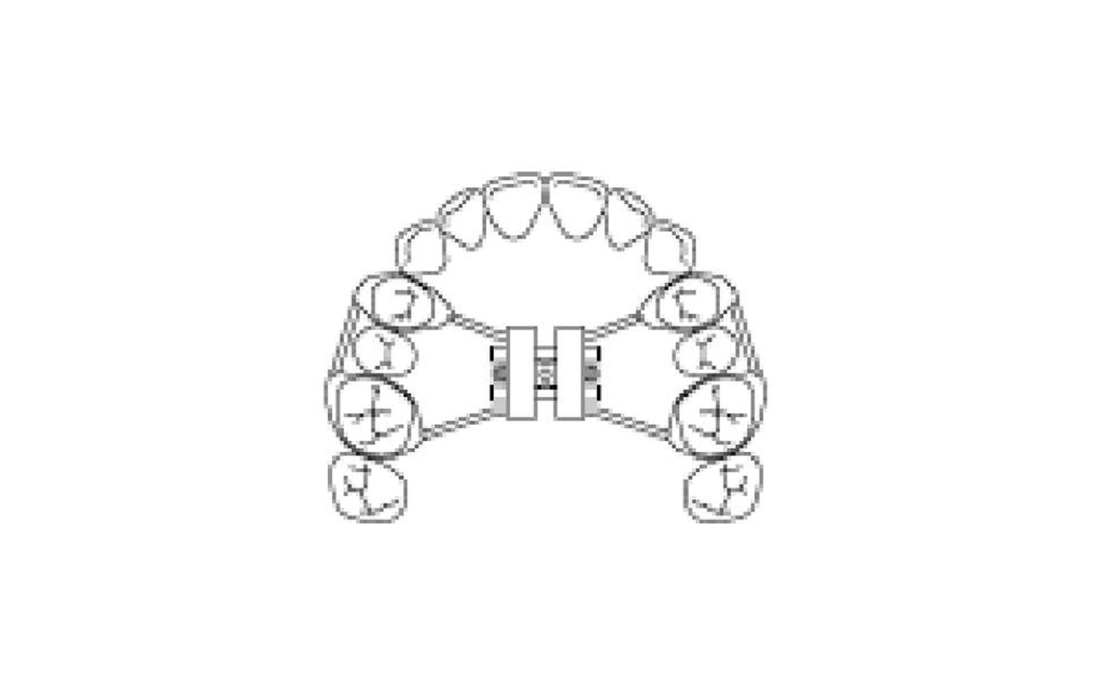 Patterson® expansion screws – rapid palatal expansion screw, maximum expansion